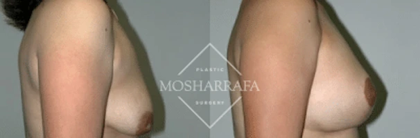 Before and after breast surgery results, side view