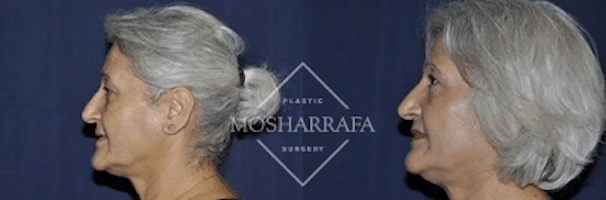 Before and after profile views of patient's face showing facial rejuvenation results