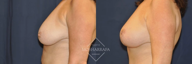 Before and after side view of breast augmentation results