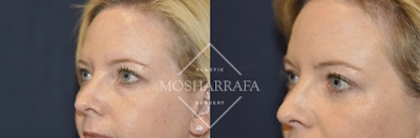 Before and after profile views showing case 184 results