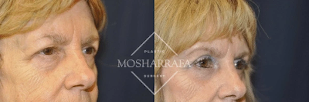 Before and after profile views showing case 185 results