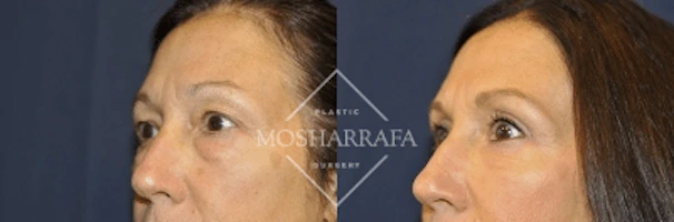 Side profile before and after comparison of patient's facial contours and profile