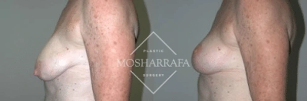 Before and after breast surgery results, side view