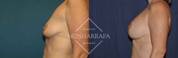 Before and after side profile showing breast augmentation results