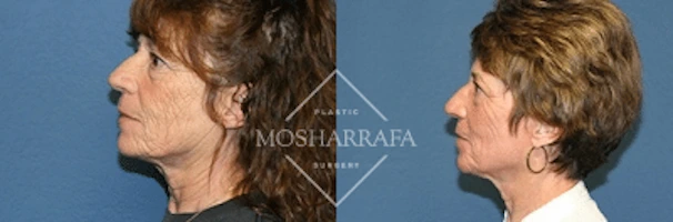 Before and after profile views of patient's face showing facial rejuvenation results