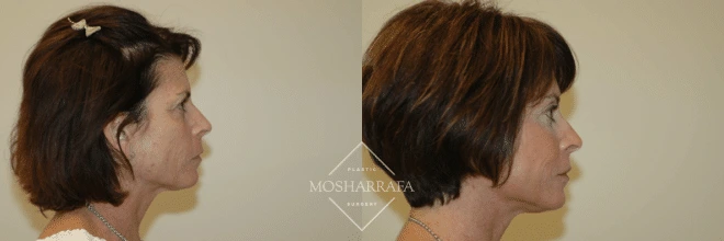 Before and after side profile comparison of a woman's face showing results of facial contouring