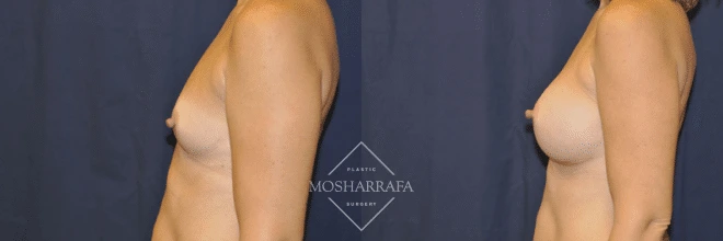 Before and after side profile comparison of breast augmentation results
