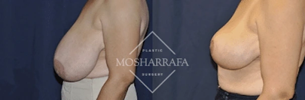 Before and after side view of breast surgery results