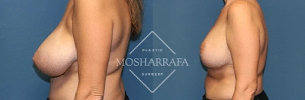Before and after side view of breast surgery results