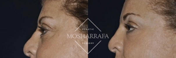 Before and after side profile view of patient's face showing facial contours