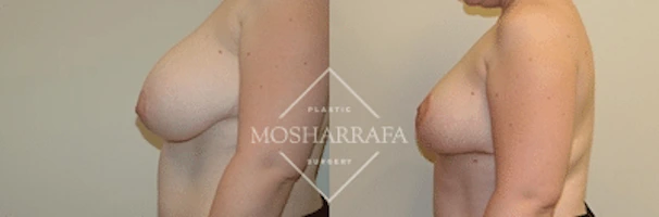 Before and after side profile of breast augmentation results