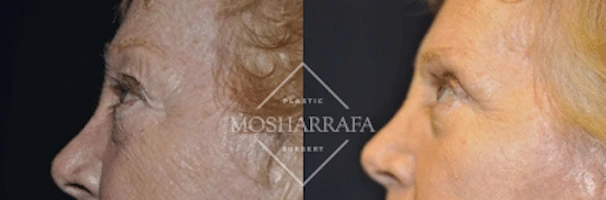 Before and after profile comparison showing facial rejuvenation results