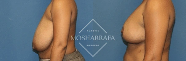 Before and after side view of breast augmentation results