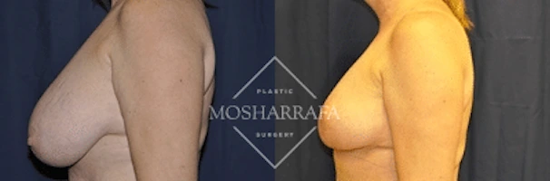 Breast lift surgery before and after, side view comparison
