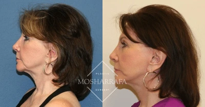 Before and after profile views of a patient's face and neck