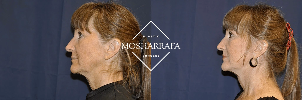 Before and after side profile of a woman showing neck and lower face refinement