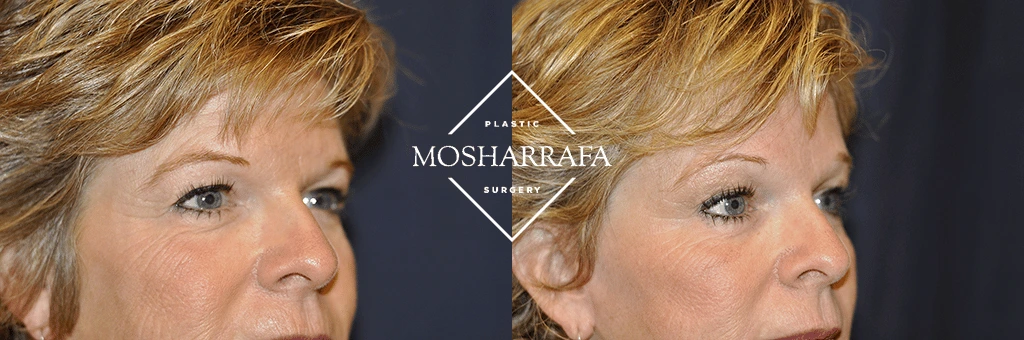 Before and after profile comparison showing facial lift and skin tightening results