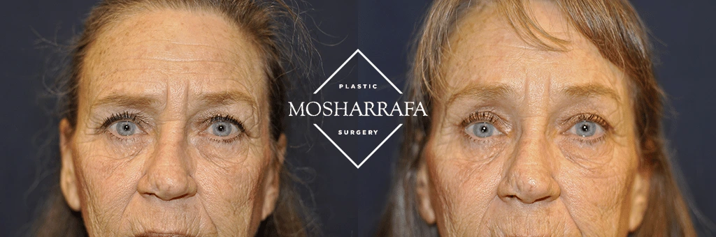 Before and after front-facing views of patient showing facial rejuvenation results at Mosharrafa Surgery