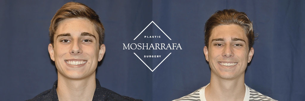 Before and after front-facing views of male patient following facial contouring at Mosharrafa Surgery