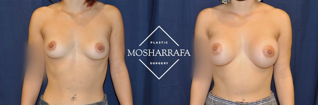 Before and after front view of breast augmentation results at Mosharrafa Surgery