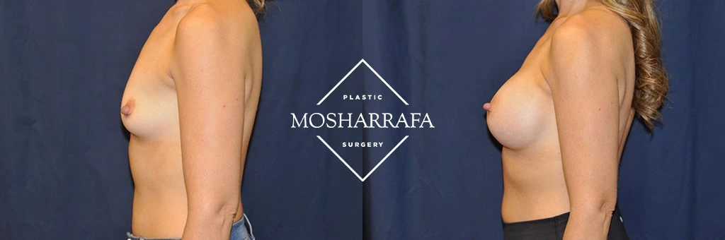 Before and after side profile view of breast augmentation results at Mosharrafa Surgery