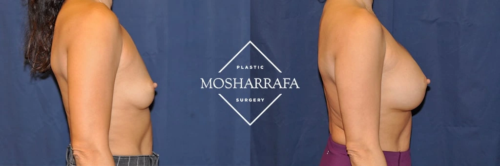 Breast augmentation before and after, side view