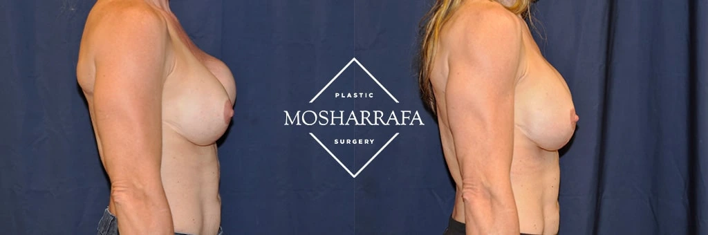 Side-by-side breast augmentation before and after comparison, patient shown from side angle