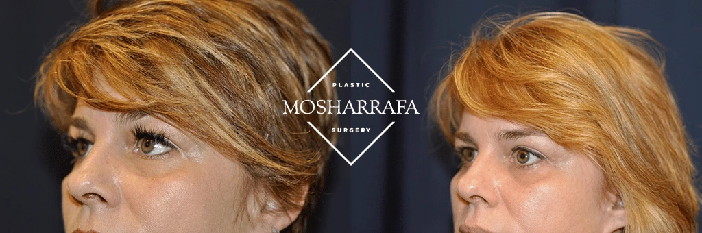 Before and after profile comparison showing facial lift and skin tightening outcomes