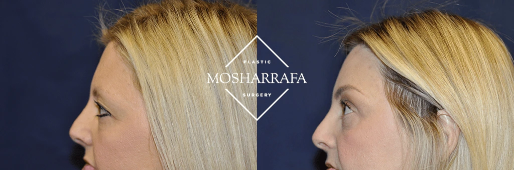 Before and after profile views showing facial contour changes