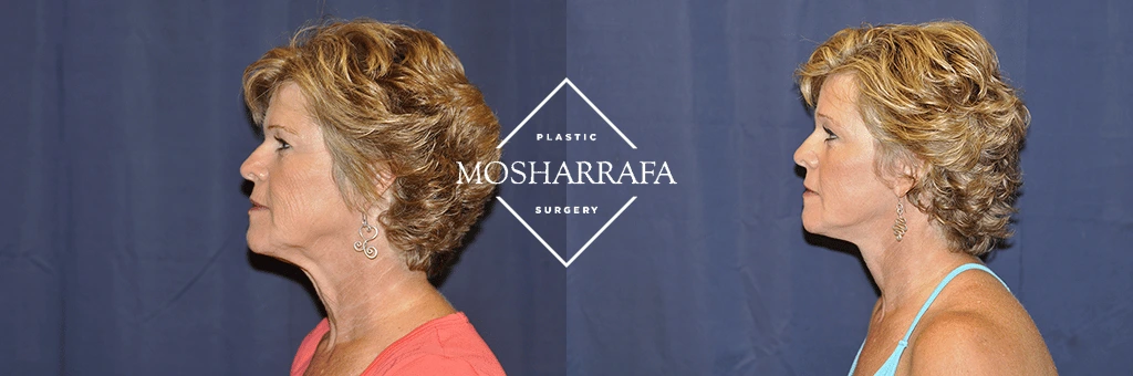 Before and after profile views of a patient with improved neck definition and lifted facial contours