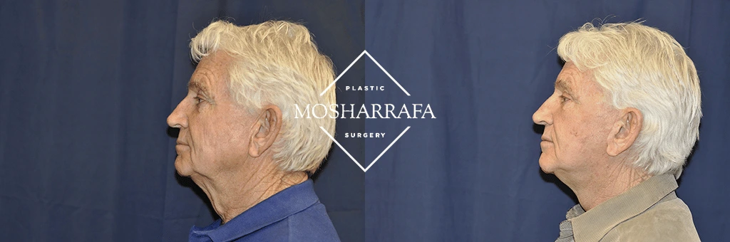 Before and after profile view of man's face showing facial rejuvenation results