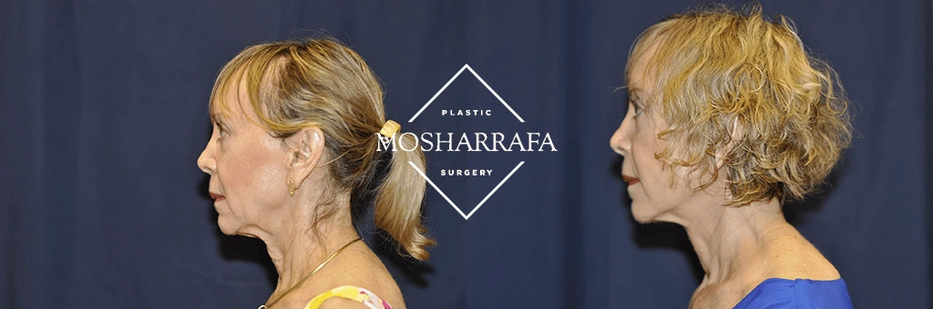 Female patient side profile views before and after facelift procedure