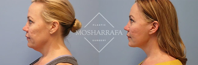 Before and after profile views of facelift results showing improved neck definition and facial rejuvenation