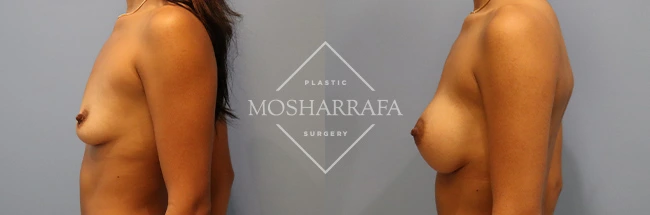 Before and after side profile view of breast augmentation results