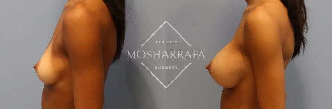 Before and after side-view comparison of breast augmentation results