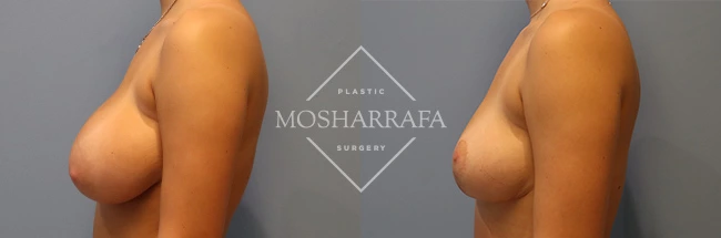 Breast augmentation surgery before and after, side view comparison