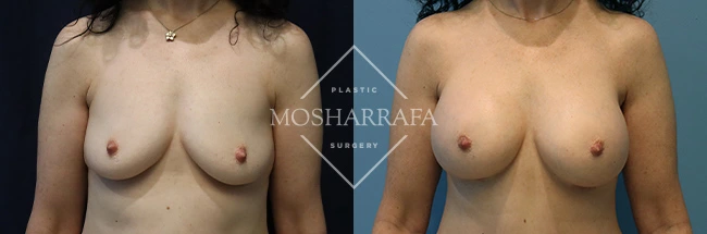 Breast augmentation before and after comparison, front view with different lighting