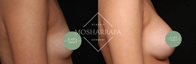 Before and after breast augmentation surgery, angle view with privacy circles
