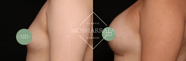 Before and after breast augmentation results, side view