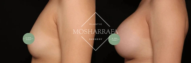 Before and after breast augmentation results, side view