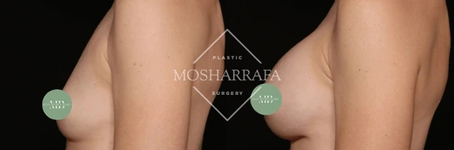 Before and after breast augmentation results, side view