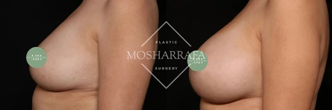 Before and after breast augmentation results, side view