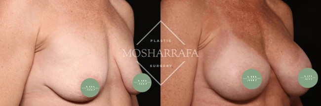 Before and after breast augmentation results, front view