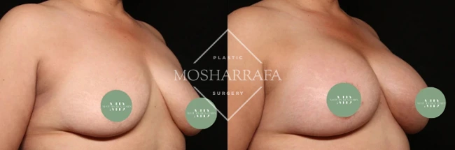 Before and after breast augmentation results, front view