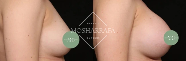 Before and after breast augmentation results, side view comparison