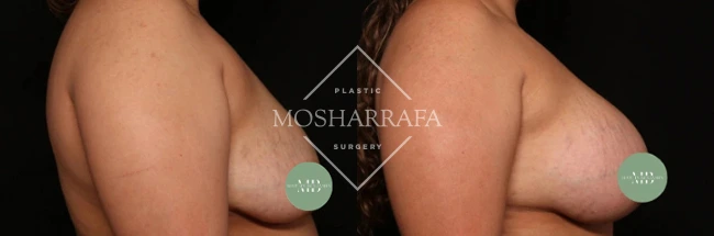 Before and after breast augmentation results, back view comparison