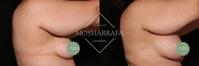 Before and after side profile showing breast augmentation results