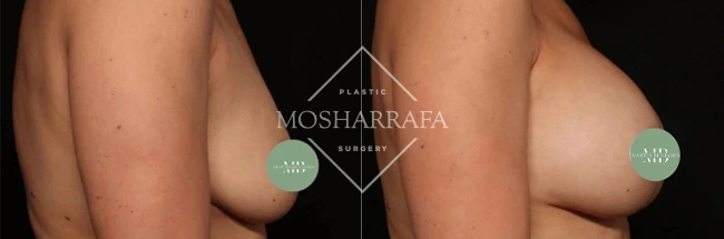 Before and after side profile showing breast augmentation results
