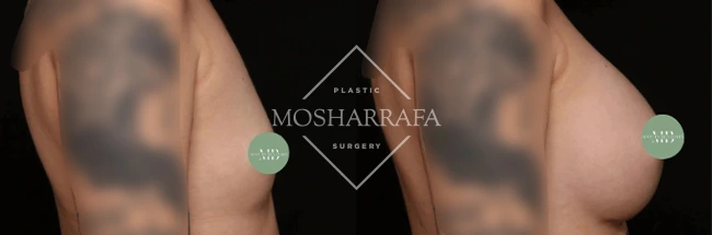 Before and after front view showing breast augmentation results