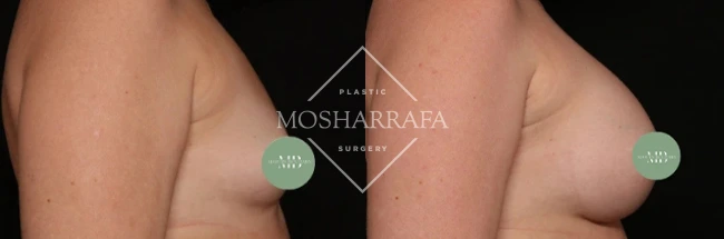 Side profile views of breast augmentation results with measurement markers